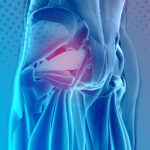 Sciatalgia: non sempre è colpa dell’ernia