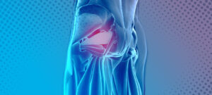 La sindrome del piriforme causa frequente di sciatalgia-saragallo